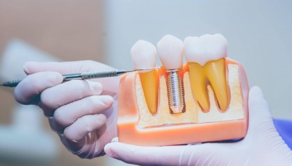 全球牙科龙头登士柏被指以次充好 或涉8万余患者