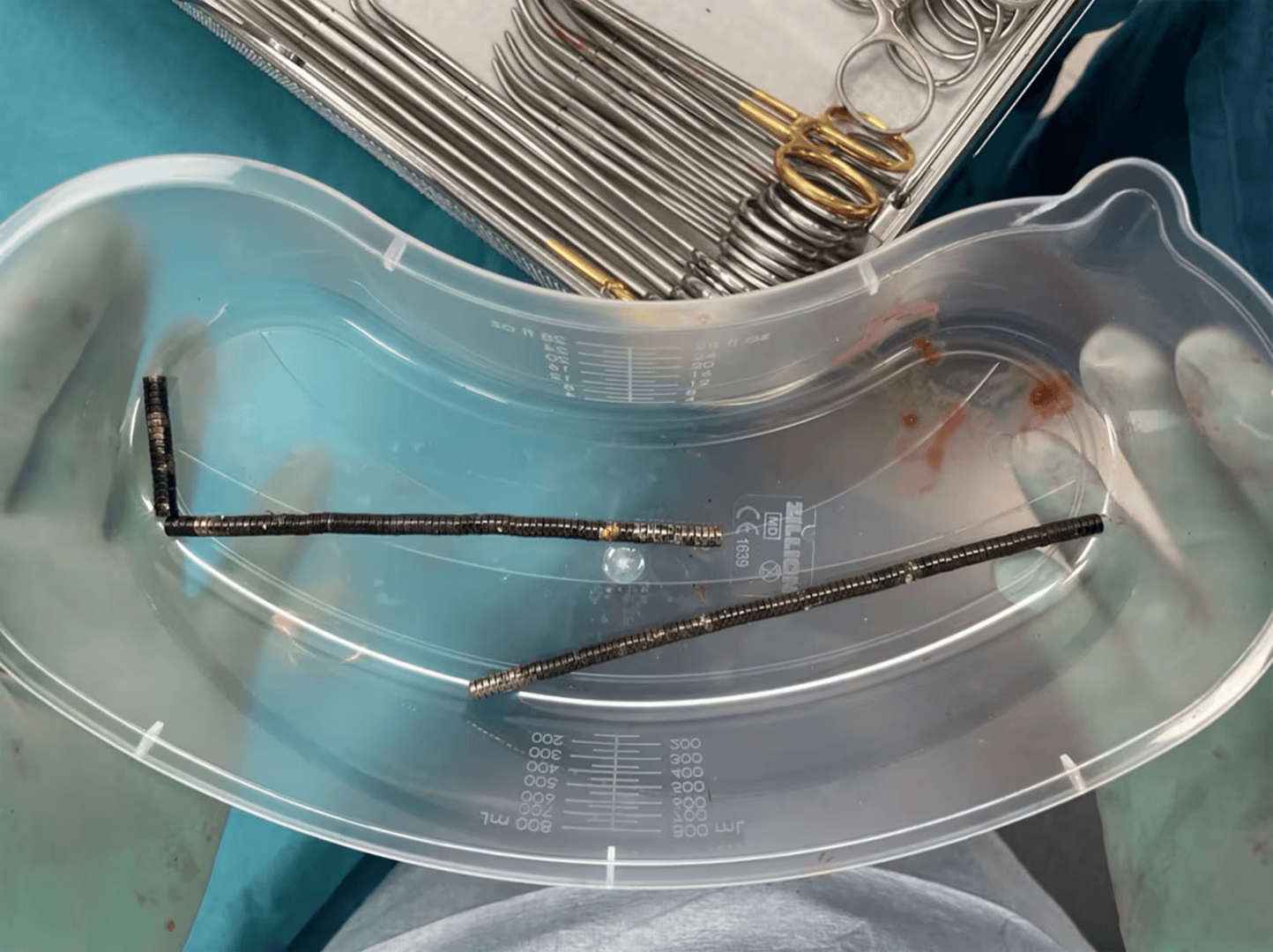 腹痛4天后送医,新西兰男孩吞下约100颗磁铁致肠道坏死 医生切除部分肠组织